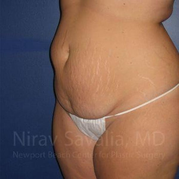 Liposuction Before & After Gallery - Patient 1655647 - Before