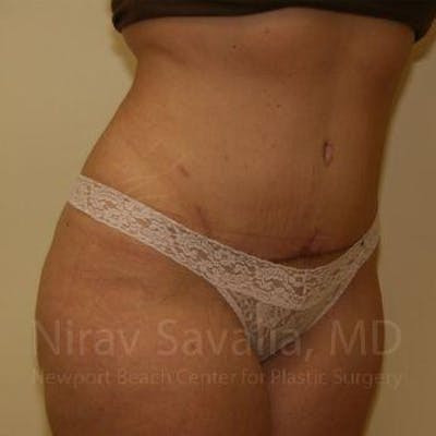 Abdominoplasty Tummy Tuck Before & After Gallery - Patient 1655647 - After