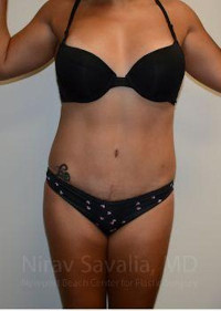 Abdominoplasty Tummy Tuck Before & After Gallery - Patient 1655653 - Image 2