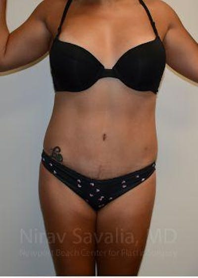 Body Contouring after Weight Loss Before & After Gallery - Patient 1655653