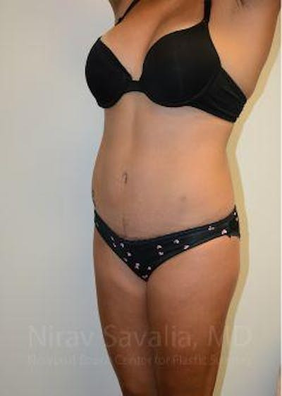 Abdominoplasty Tummy Tuck Before & After Gallery - Patient 1655653 - After