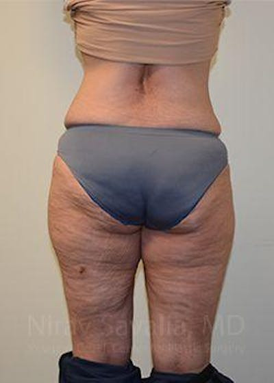 Fat Grafting to Face Before & After Gallery - Patient 1655654 - After