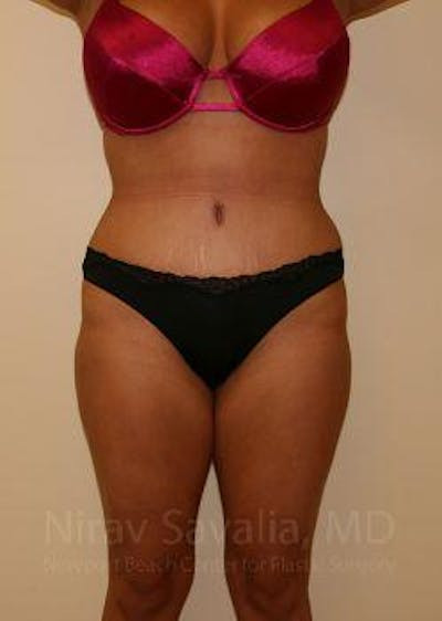 Mastectomy Reconstruction Revision Before & After Gallery - Patient 1655656 - After