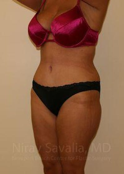 Breast Lift with Implants Before & After Gallery - Patient 1655656 - After
