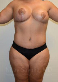 Abdominoplasty Tummy Tuck Before & After Gallery - Patient 1655657 - Image 2