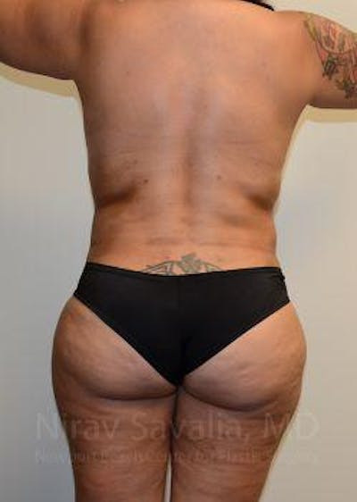 Thigh Lift Before & After Gallery - Patient 1655657 - After