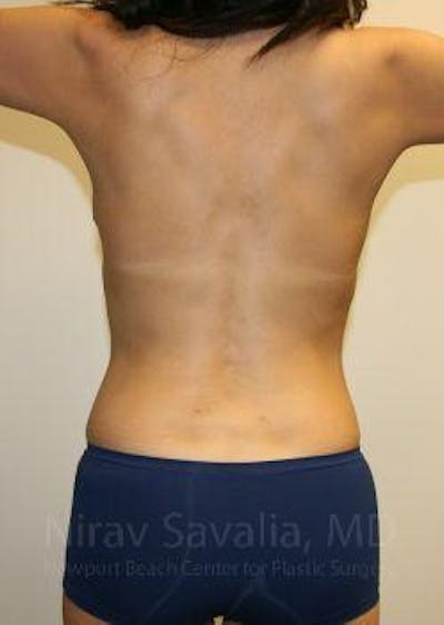 Liposuction Before & After Gallery - Patient 1655658 - After