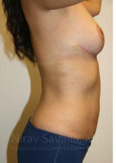 Breast Explantation En Bloc Capsulectomy Before & After Gallery - Patient 1655658 - After