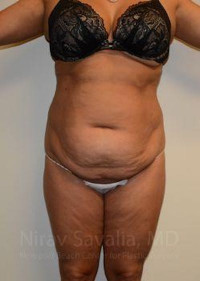 Abdominoplasty Tummy Tuck Before & After Gallery - Patient 1655659 - Image 1