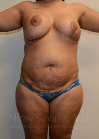 Liposuction Before & After Gallery - Patient 1655660 - Image 1