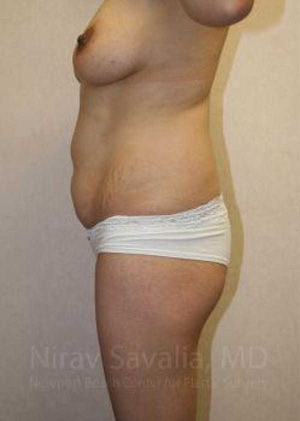 Abdominoplasty Tummy Tuck Before & After Gallery - Patient 1655661 - Before