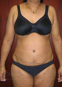 Liposuction Before & After Gallery - Patient 1655665 - Image 2