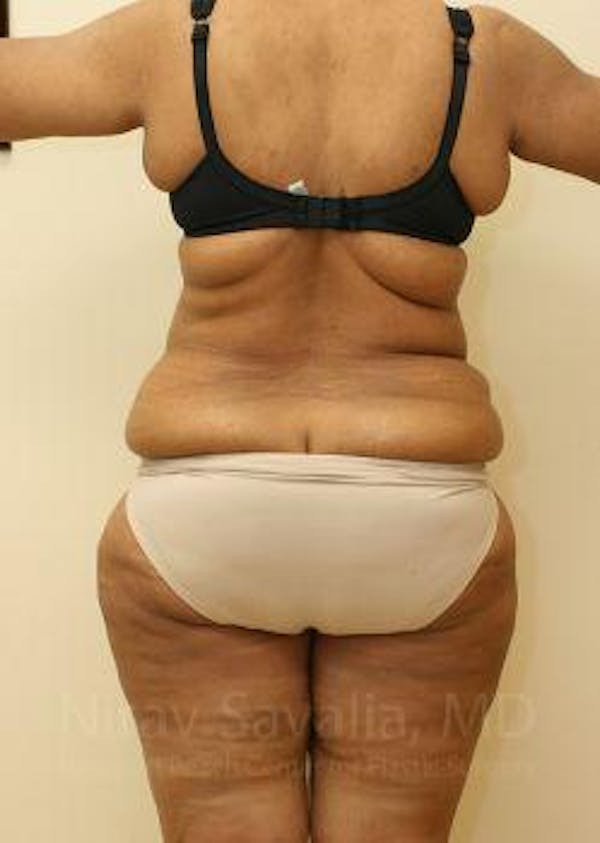 Liposuction Before & After Gallery - Patient 1655665 - Before