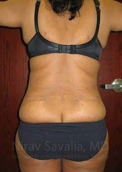 Liposuction Before & After Gallery - Patient 1655665 - After