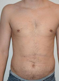 Liposuction Before & After Gallery - Patient 1655667 - Image 2