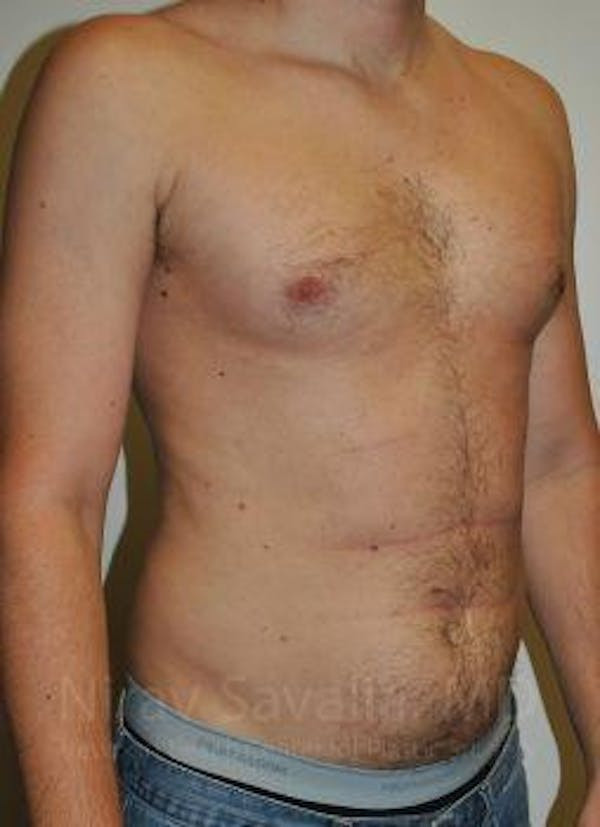 Liposuction Before & After Gallery - Patient 1655667 - Before