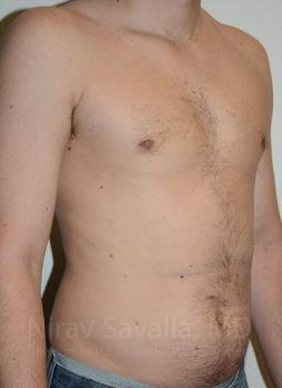 Breast Implant Revision Before & After Gallery - Patient 1655667 - After