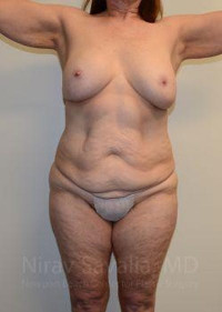 Liposuction Before & After Gallery - Patient 1655673 - Image 1