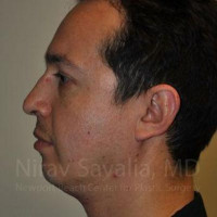 Chin Implants Before & After Gallery - Patient 1655678 - Image 1