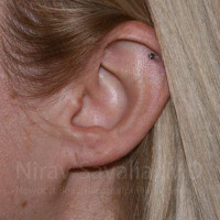 Torn Earlobe Repair Ear Gauge Repair Before & After Gallery - Patient 1655679 - Image 1