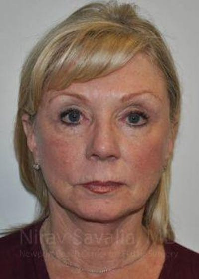 Facelift Before & After Gallery - Patient 1655682 - After