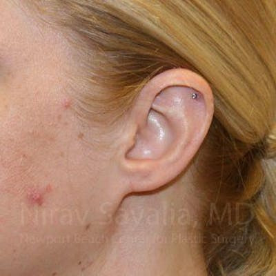 Fat Grafting to Face Before & After Gallery - Patient 1655679