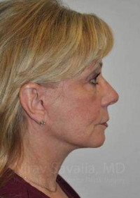 Facelift Before & After Gallery - Patient 1655682 - Image 2