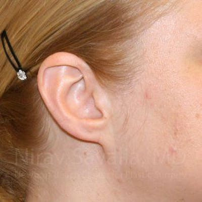 Torn Earlobe Repair Ear Gauge Repair Before & After Gallery - Patient 1655679 - After