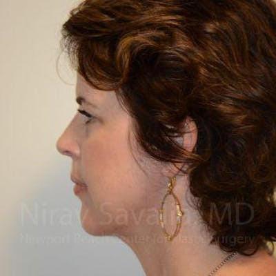 Torn Earlobe Repair Ear Gauge Repair Before & After Gallery - Patient 1655683 - After