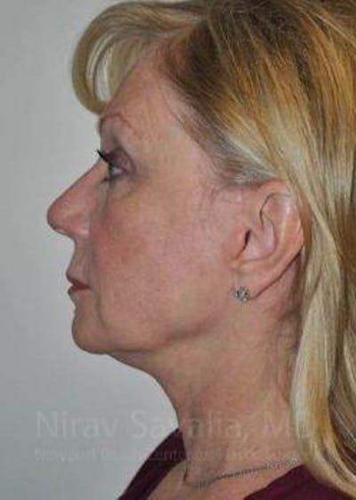 Arm Lift Before & After Gallery - Patient 1655681 - After