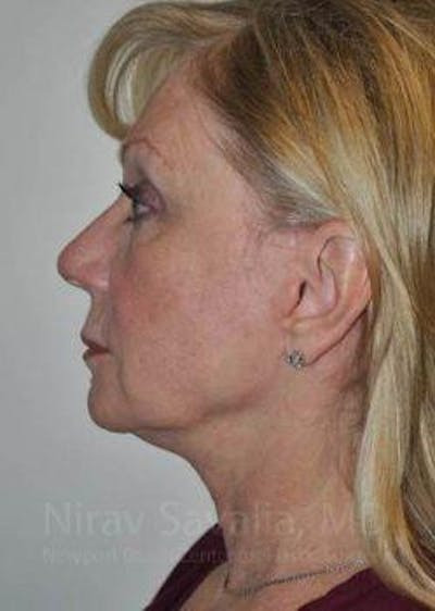 Facelift Before & After Gallery - Patient 1655682 - After