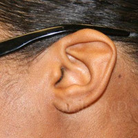 Torn Earlobe Repair Ear Gauge Repair Before & After Gallery - Patient 1655684 - Image 1