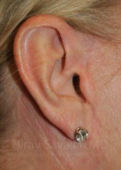 Torn Earlobe Repair Ear Gauge Repair Before & After Gallery - Patient 1655681 - After