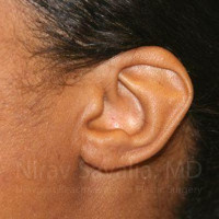 Torn Earlobe Repair Ear Gauge Repair Before & After Gallery - Patient 1655684 - Image 2