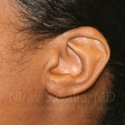 Torn Earlobe Repair Ear Gauge Repair Before & After Gallery - Patient 1655684