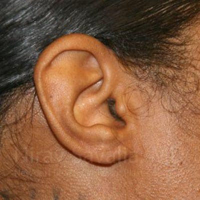 Torn Earlobe Repair Ear Gauge Repair Before & After Gallery - Patient 1655684 - After