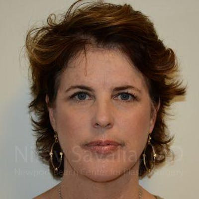 Facelift Before & After Gallery - Patient 1655689 - After