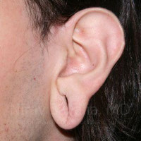Torn Earlobe Repair Ear Gauge Repair Before & After Gallery - Patient 1655686 - Image 1