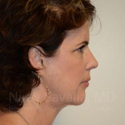 Torn Earlobe Repair Ear Gauge Repair Before & After Gallery - Patient 1655689
