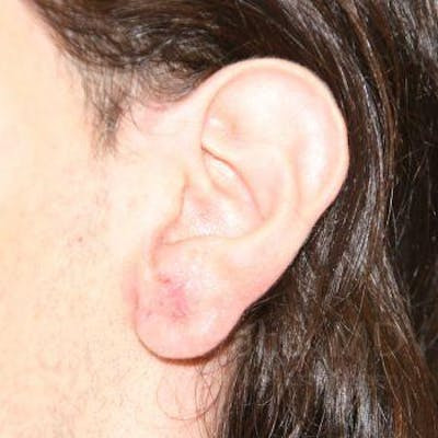 Torn Earlobe Repair Ear Gauge Repair Before & After Gallery - Patient 1655686