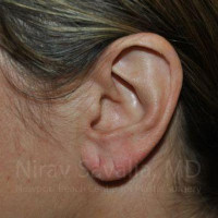 Torn Earlobe Repair Ear Gauge Repair Before & After Gallery - Patient 1655691 - Image 1