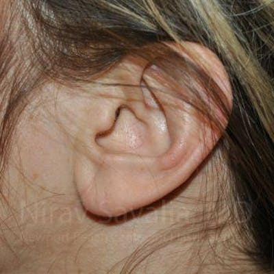 Torn Earlobe Repair Ear Gauge Repair Before & After Gallery - Patient 1655691 - After