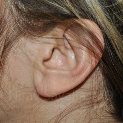Torn Earlobe Repair Ear Gauge Repair Before & After Gallery - Patient 1655691