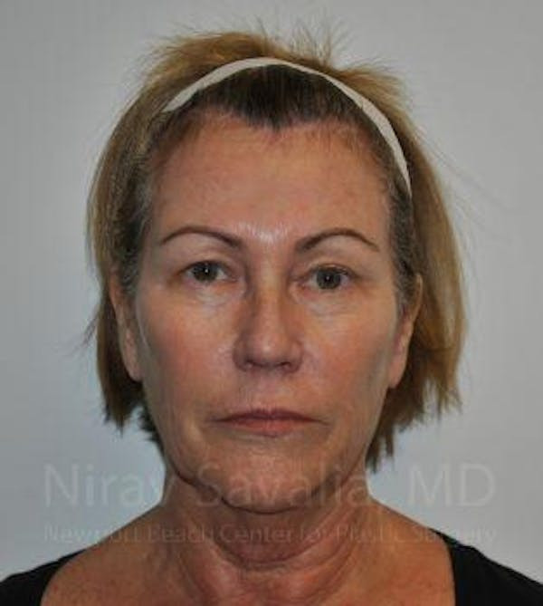 Facelift Before & After Gallery - Patient 1655695 - Before