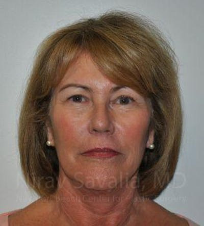 Facelift Before & After Gallery - Patient 1655694 - After