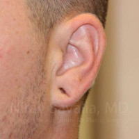 Torn Earlobe Repair Ear Gauge Repair Before & After Gallery - Patient 1655692 - Image 1