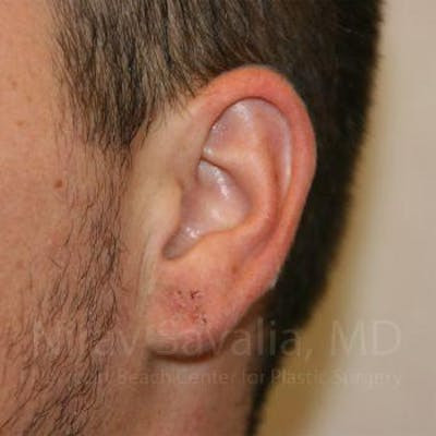 Torn Earlobe Repair Ear Gauge Repair Before & After Gallery - Patient 1655692 - After