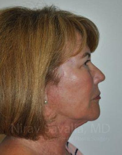 Chin Implants Before & After Gallery - Patient 1655695