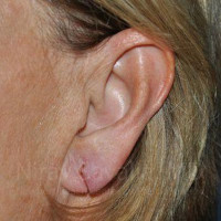 Torn Earlobe Repair Ear Gauge Repair Before & After Gallery - Patient 1655697 - Image 1