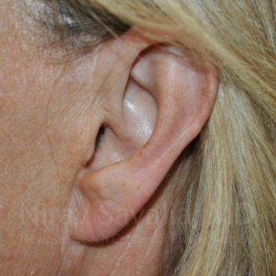 Torn Earlobe Repair Ear Gauge Repair Before & After Gallery - Patient 1655697